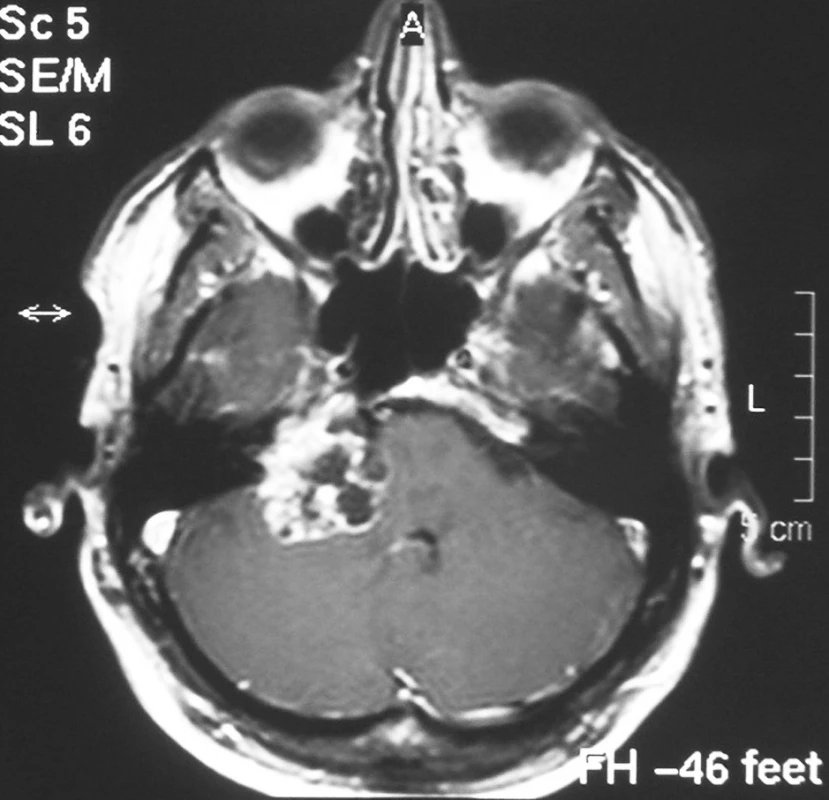 Cysticky degenerovaný tumor vyplňující mostomozečkový kout vpravo zasahující do rozšířeného vnitřního zvukovodu a usurující hrot pyramidy. Nádor komprimuje přilehlou mozečkovou hemisféru, mozkový kmen a působí tlakové změny na IV. mozkové komoře (4a. stupně). Postkontrastně se sytí solidní porce tumoru (T1SE + Gadolinium).