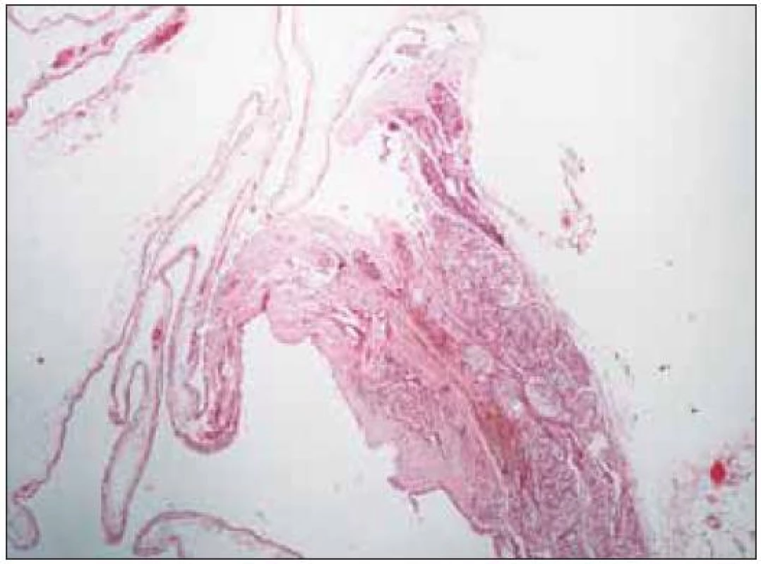 Histologický nález parathyreoidální cysty, barveno hematoxylin-eosinem, zvětšeno 40x.