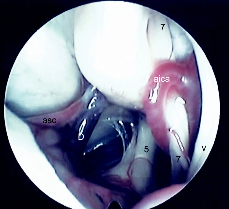 Endoskopia PC uhla vpravo. Pohľad do strednej a hornej časti. V obraze je neurovaskulárny konflikt aica a n. VII. Aica veľkého kalibru „škrtí“ n. VII a súčasne nerv mierne dislokuje nahor.