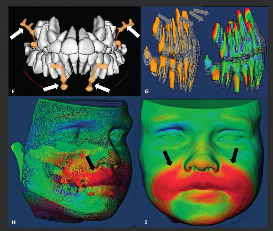 Trojrozměrná analýza maxilární protrakce s intermaxilárními gumičkami a minidlahami.