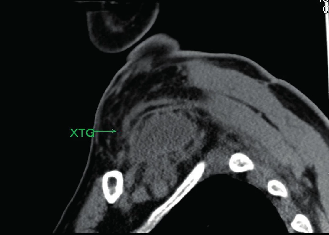 CT zobrazení xantogranulomu (XTG) pravého nadklíčku, sagitální řez.