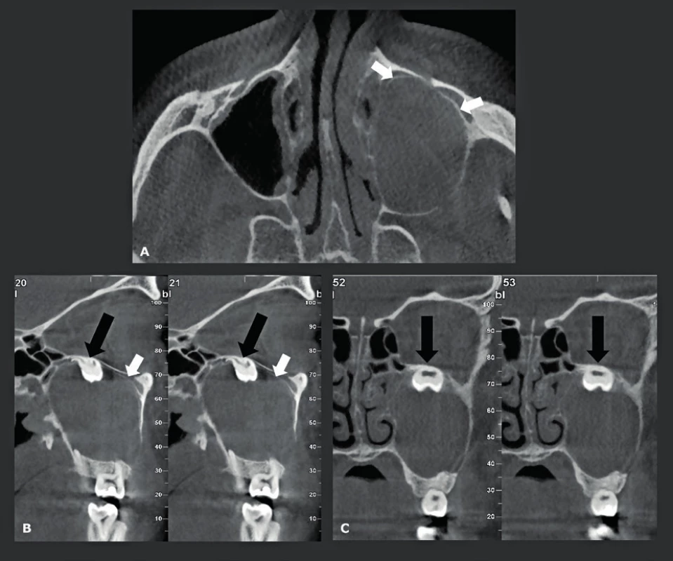 Onemocnění maxilárních dutin odontogenního původu - keratocysta.