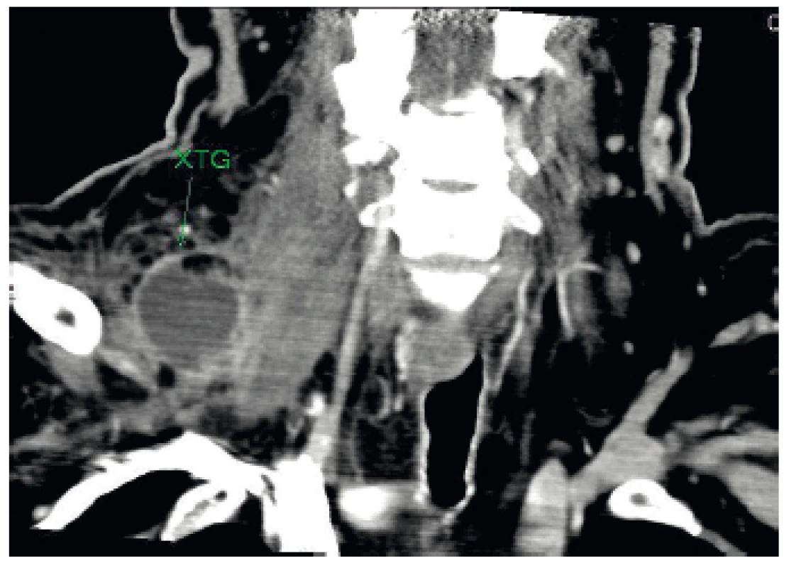 CT zobrazení xantogranulomu (XTG) pravého nadklíčku, koronární řez.
