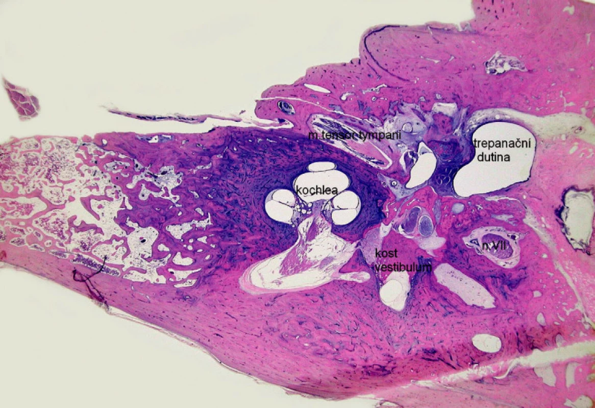 Osifikující labyrintitida – novotvořená kost v oblasti vestibula vnitřního ucha. Kazuistika 4. - histologický obraz, horizontální řez pravou spánkovou kostí, barvení hematoxylin eozin.