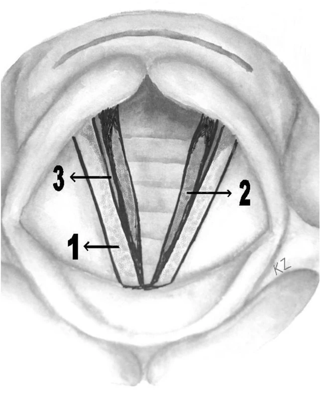 Schematické znázornění pseudosulcus vocalis. Jedná se o zářez (3), který vzniká mezi subglotickým otokem vznikajícím po podráždění sliznice refluxátem (2) a vlastní hlasivkou (1). Celkový obraz připomíná „částečně otevřený rohlík hot-dogu“.