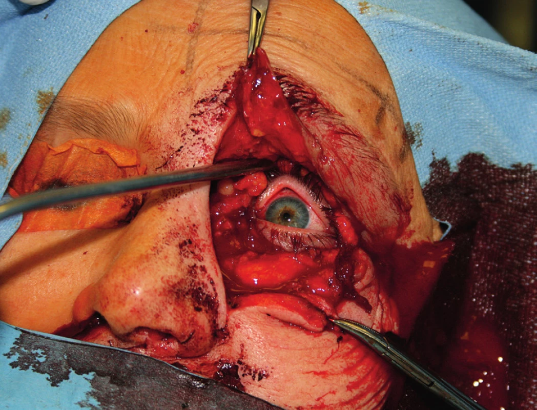 Operace – mediální maxilektomie s exenterací očnice.
