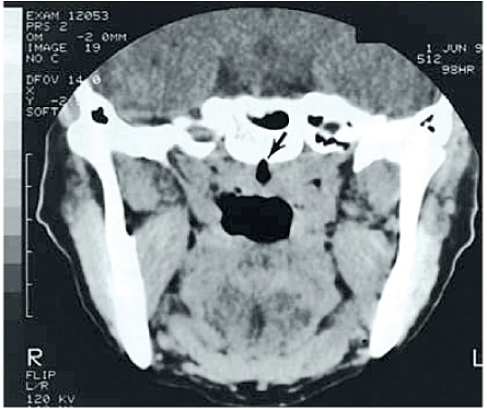 Natívne CT – transverzálna projekcia. Burza faryngea označená šípkou.
