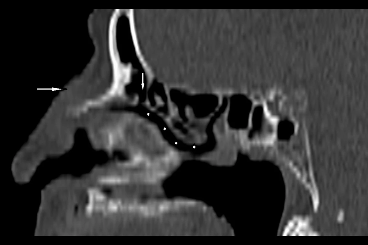 CT obličejového skeletu, kostní algoritmus, sagitální rekonstrukce. Frontální dutina a její vývod (vertikální šipka) jsou volné, zachycené etmoidální sklípky a klínová dutina jsou bez patologických změn. Rozšíření měkkých tkání v oblasti hřbetu nosu (horizontální šipka).