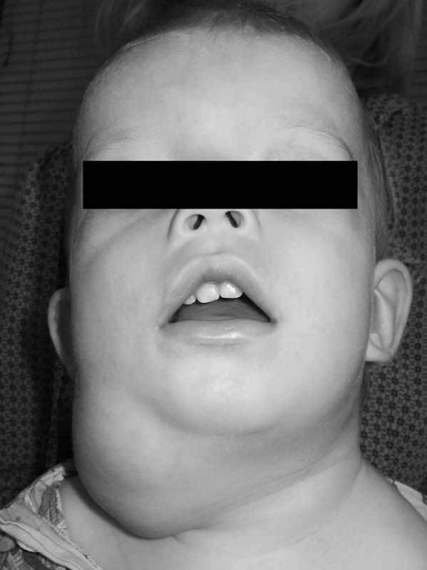 Branchiogenní krční cysta vpravo u dítěte s branchiootickým syndromem.