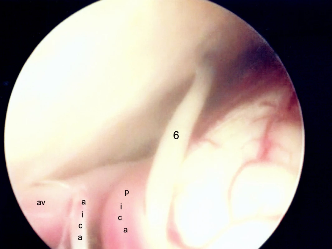 Endoskopia PC uhla vľavo. Pohľad do dolnej a prednej časti na odstupy aica a pica z a. vertebralis a na n.VI.