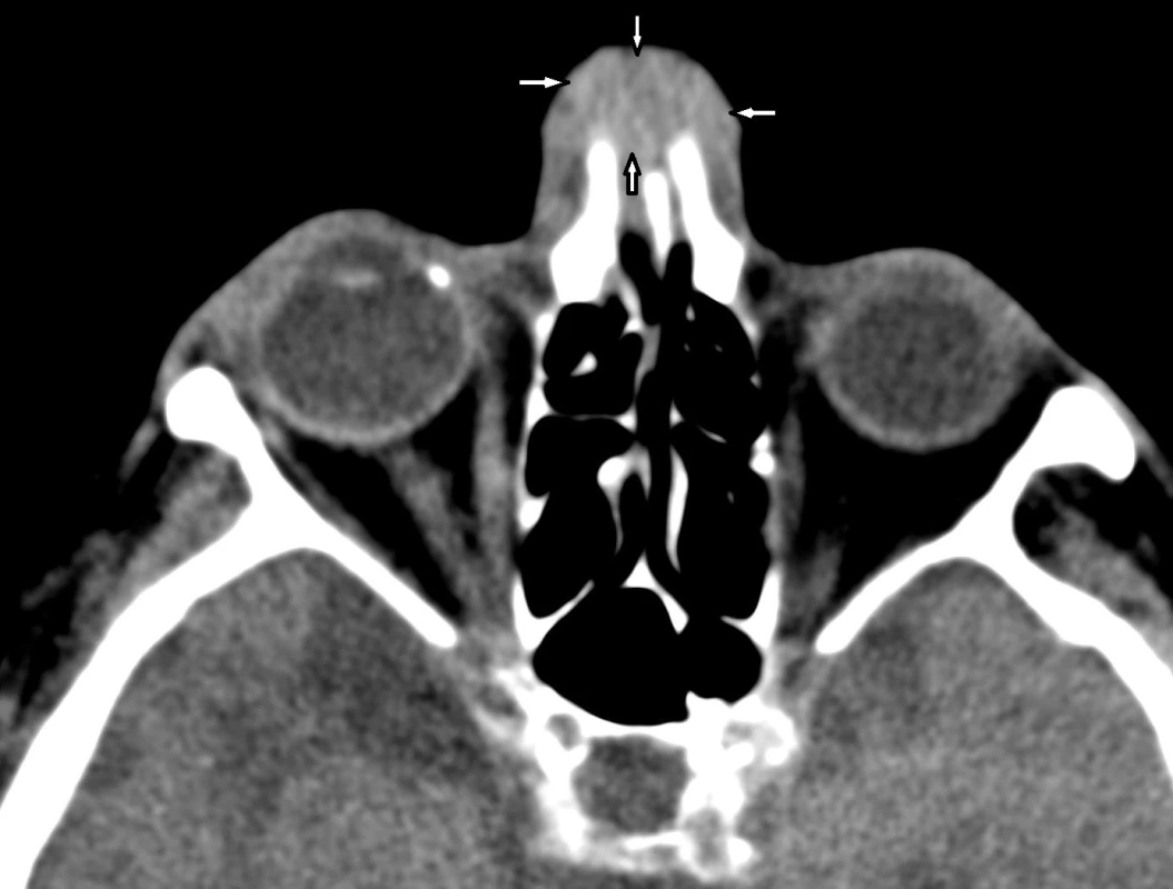 CT obličejového skeletu, axiální rovina, měkkotkáňový algoritmus. Homogenní měkkotkáňová masa (šipky) v podkoží kořene nosu s propagací mezi nosní kůstky směrem k nosnímu septu.