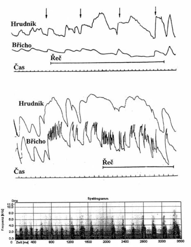 Pneumografické záznamy tonického (nahoře) a klonického koktání (uprostřed) [27]. Sonagrafická analýza („Visible speech”) dlouhého tonoklonu (dole).