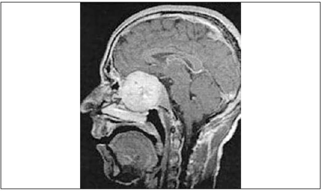 Pacient s chondrosarkomem nosní dutiny, který se propaguje přes rinobazi, na MRI (sagitální projekce). Proces je uložen cca 4 cm od nosního vchodu (šipka), což neumožňuje odhalení při prosté přední rinoskopii; nezbytnost endoskopického vyšetření při stížnosti na nosní neprůchodnost je evidentní. (Pozn.: pacient byl nškolik mšsíců „léčen“ lokálním KS sprejem pro domnělou alergickou rinitidu před tím, než byl na ORL ambulanci vyšetřen rigidním epifaryngoskopem).