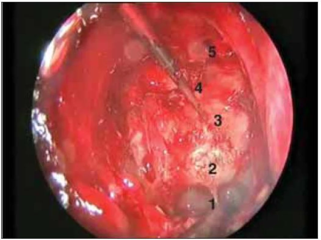 Peroperační foto – endoskopický pohled do klínové dutiny.
1. klivální reces, 2. turecké sedlo, 3. tuberkulum sedla, 4.planum sfenoidale, 5. zadní čichové sklípky