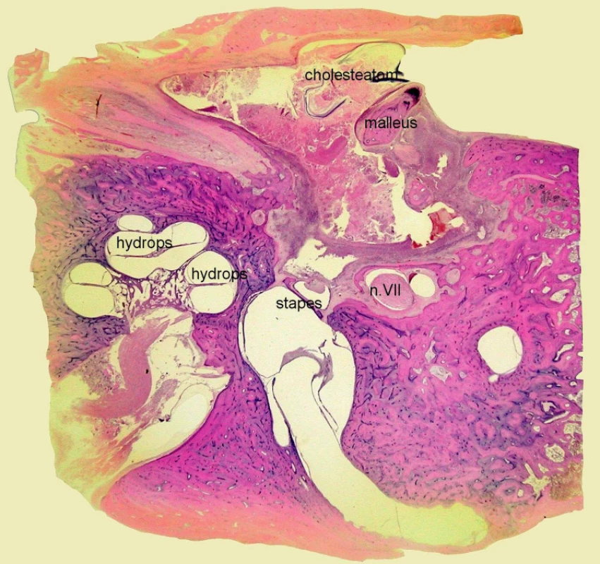 Akutní serózní (toxická) labyrintitida – endolymfatický hydrops. Mikrodehiscence kanálu lícního nervu. Kazuistika 1. - histologický obraz, horizontální řez pravou spánkovou kostí, barvení hematoxylin eozin.