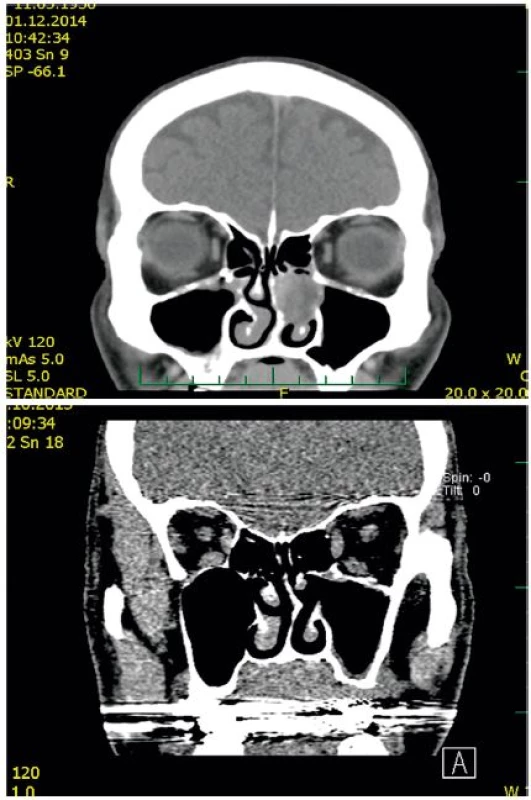 CT vyšetření pacienta před a po operaci.
