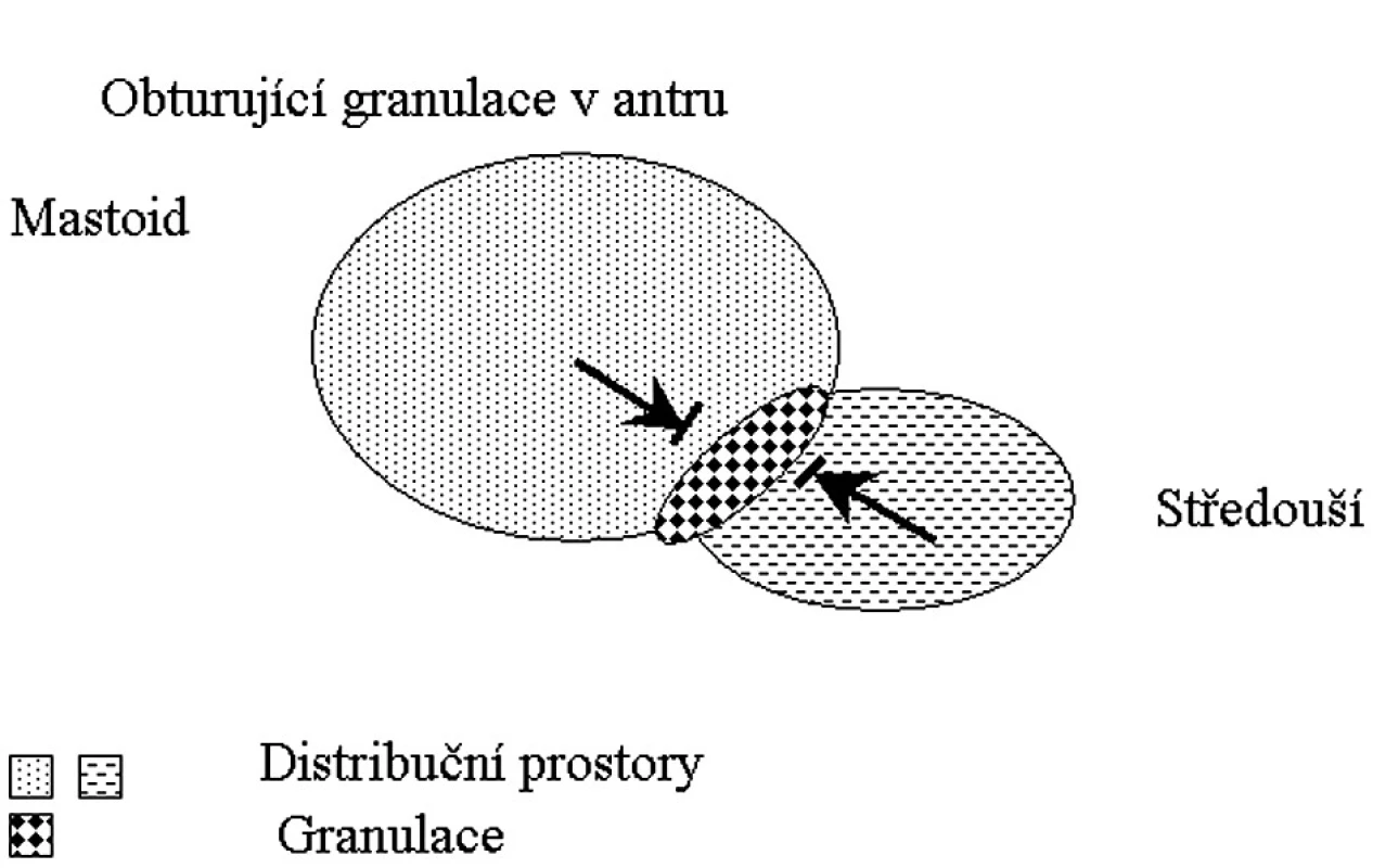 Distribuční prostory v případě obturace v antrum mastoideum.