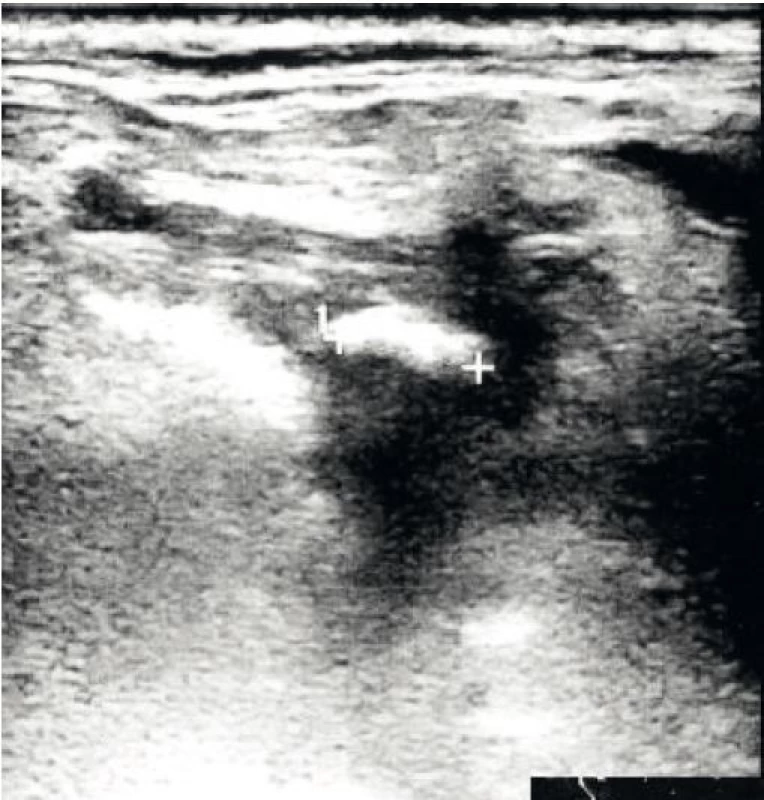 Ultrazvukový obraz sialitu podčelistní slinné žlázy vpravo (S- sialolit, akustické zastínění (šipka).