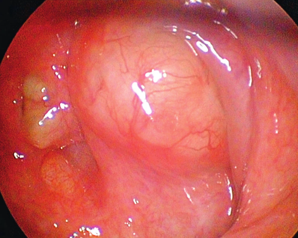 Nasofaryngeální branchiogenní cysta nosohltanu vlevo - endoskopický pohled, optika 30 st.