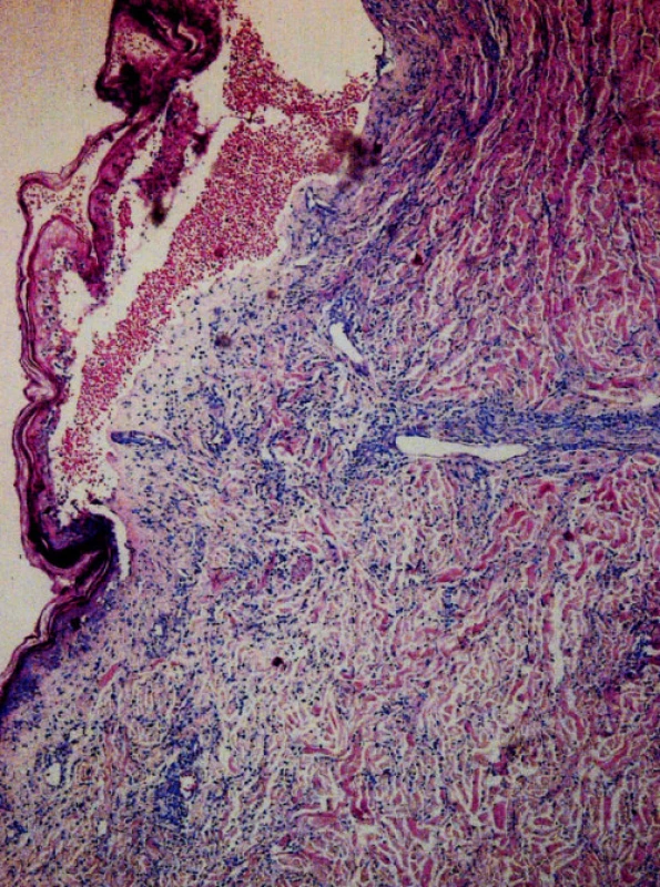 Histologický obraz blíže nespecifikovaného kožního T-lymfomu, Giemsa 60x.
