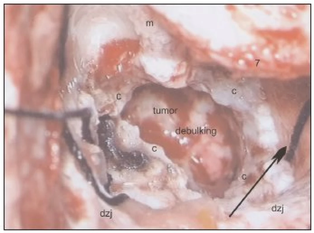 Translabyrintný prístup vpravo – operácia vo fáze urobeného debulking. Šípka ukazuje, kde prenikne mikroraspatórium do pontocerebelárnej cisterny, aby sa vypustil cerebrospinálny likvor, ktorý bude vytekať z komorového systému cez foramen Luschkae na kontralaterálnej strane, ipsilaterálny foramen Luschkae je blokovaný tumorom.
Legenda: dzj - dura mater zadnej jamy, c - puzdro tumoru, m - meatus acusticus internus, 7 - nervus facialis