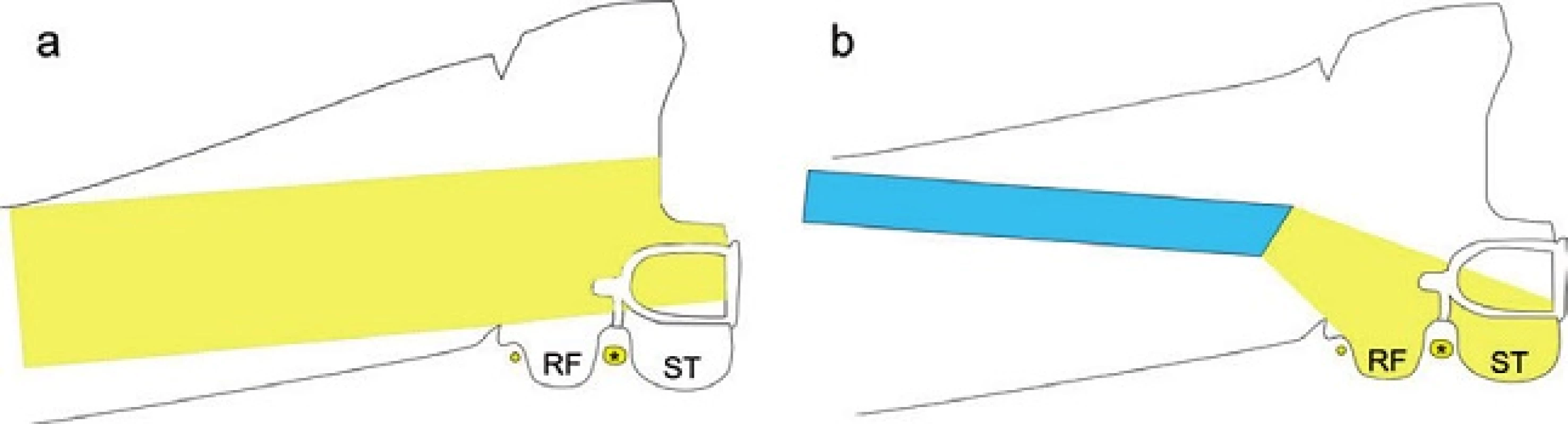 Přehlednost oblasti třmínku při použití mikroskopu (vlevo) a při použití 30stupňového endoskopu (vpravo). RF - recessus facialis, ST - sinus tympani, * tvářový nerv.