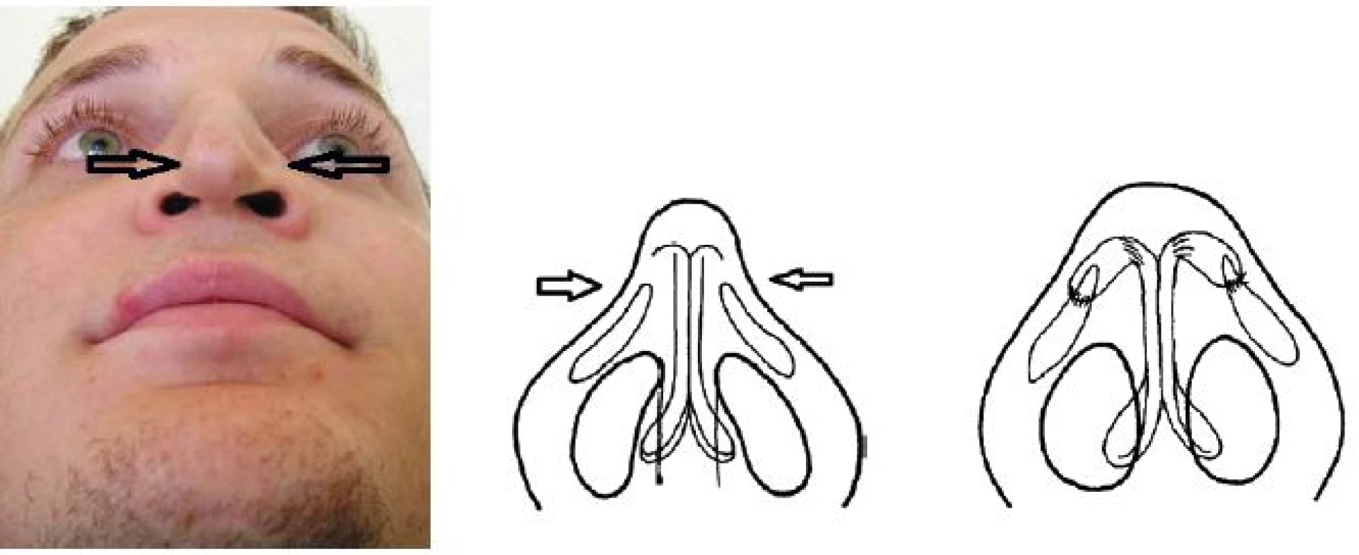 Vľavo: deformácia špičky po nadmernej resekcii alárnych chrupiek. V strede: podstata deformity, chýbanie časti alárnej chrupky. Vpravo: augmentácia chrupkovým štepom medzi dómom a laterálnym ramenom