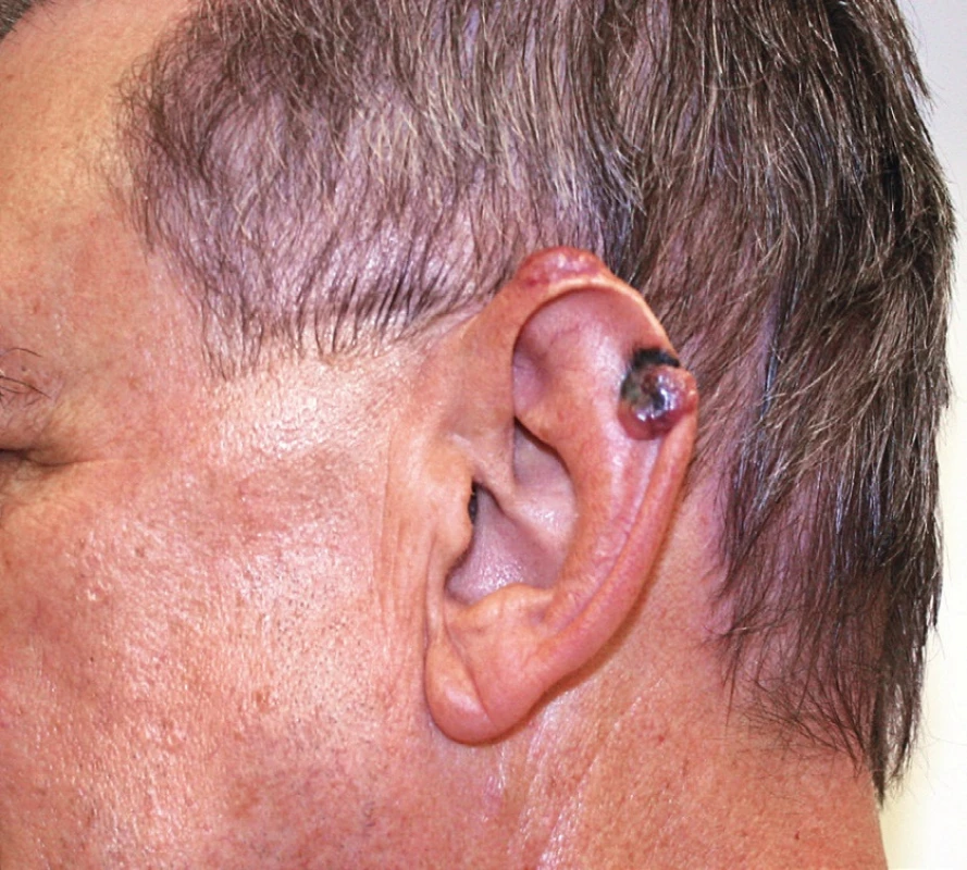 Pacient s melanomem ušního boltce – před operací.