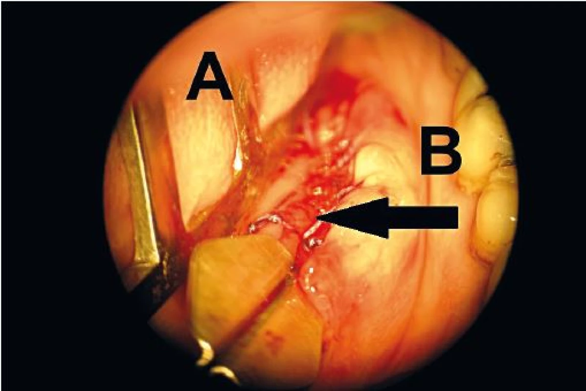 Sialodochoplastika podčelistní žlázy vlevo (A – jazyk, B – spodina ústní dutiny, šipka – vyšitá plastika).