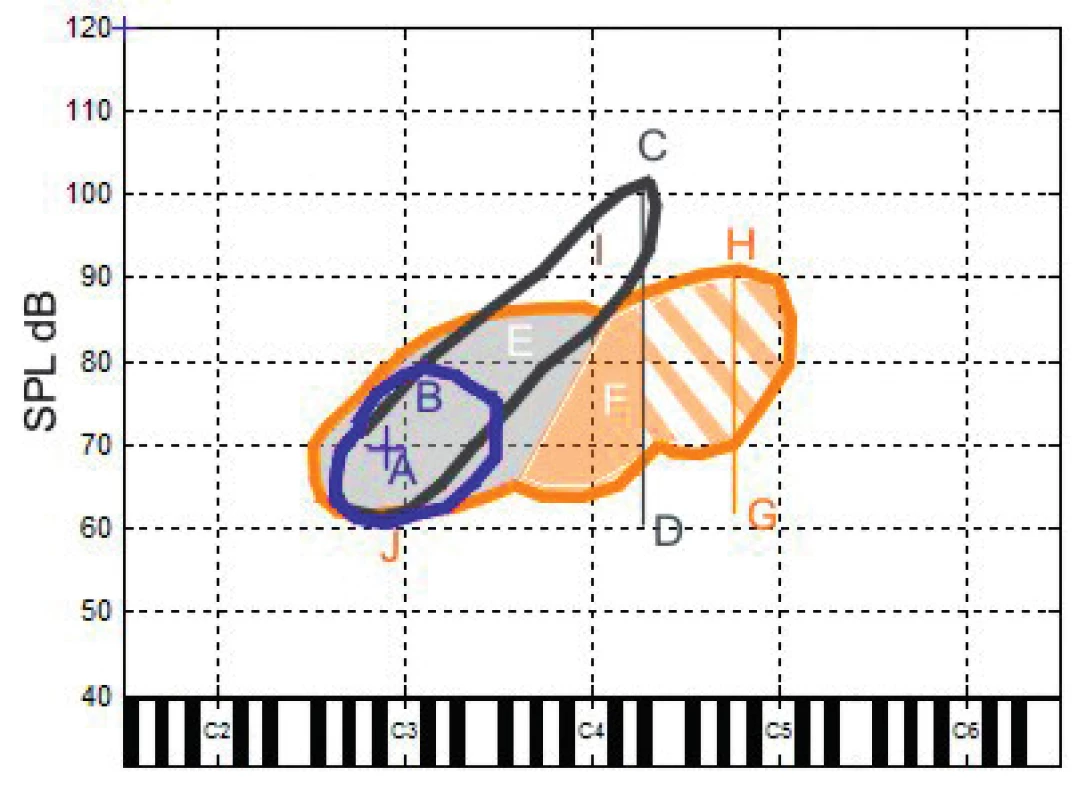 Průměrné mužské hlasové pole naměřené v naší studii. Modrá kontura ohraničuje habituální hlas, černá hlasové pole při volání, oranžová ohraničuje celkové (zpěvní) hlasové pole. Na x-ové ose je znázorněná tónová výška dle americké notaci C2-C6 odpovídají velkému C až c´´´. Písmeny jsou vyznačeny významné body hlasových polí jak jsou uvedeny v závěru studie: A – poloha průměrné výšky a intenzity habituálního hlasu, B – hodnota maximální intenzity habituálního hlasu, C – maximální intenzita při volání, D – hodnota minimální intenzity řečových úkolů, úsečka C-D – celkový dynamický rozsah řečových úkolů (habituálního hlasu a volání), E – šedivá plocha celkového zpěvního hlasového pole tvořená v modálním rejstříku, F – oranžová plocha zpěvného hlasového pole tvořená ve falzetovém rejstříku (šrafovaná oranžová plocha - plocha zpěvního hlasového pole nacházející se nad maximální výškou dosaženou při volání), G, H – hodnoty minimální a maximální intenzity zpěvního hlasového pole, úsečka G-H – dynamický rozsah VRP, I – kritický bod na křivkách maximálních SPL pro zpěvní VRP i volání (nachází se cca 1 oktávu nad polohou mluvního hlasu a je nejvíce citlivý na poruchu hlasu), J –nejtišší intenzita v oblasti výšky habituálního hlasu.
