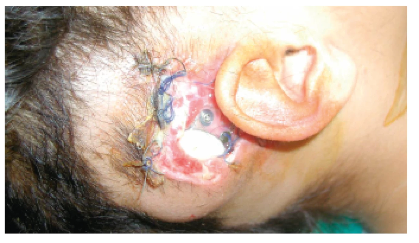 Veľká komplikácia – vylúčenie implantátu u 2-ročného dieťaťa.