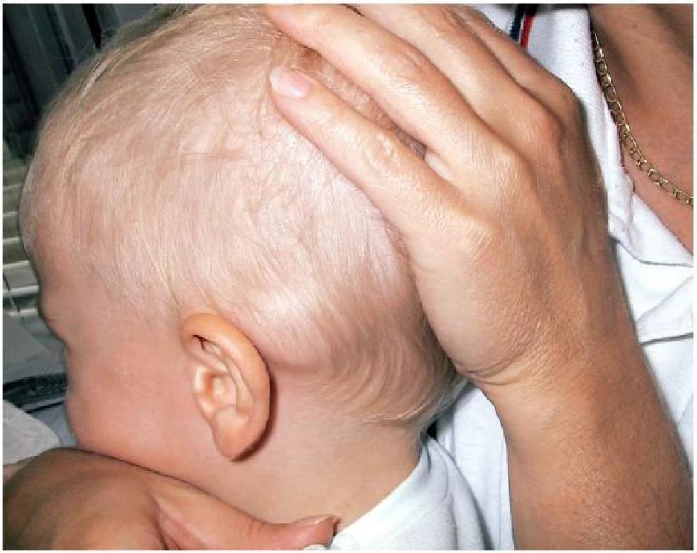 Retroaurikulárne vyklenutie vľavo u 14-mesačného chlapca.