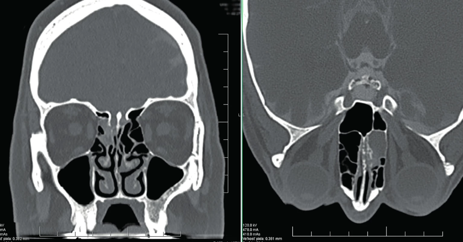 CT cisternografia predoperačne – vľavo koronárny rez, vpravo axiálny rez (poloha pacientky tvárou nadol pre zobrazenie leaku kontrastnej látky).