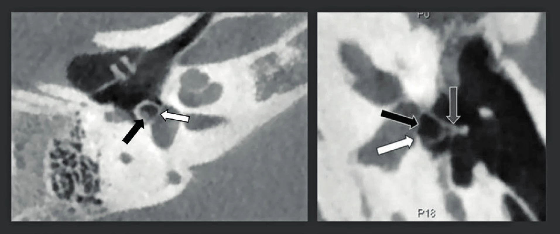 CBCT zdvojená šikmá rekonstrukce snímků středouší s vysokým rozlišením (rozlišení 150 μm) u dvou pacientů s vrozenou vadou středouší.
