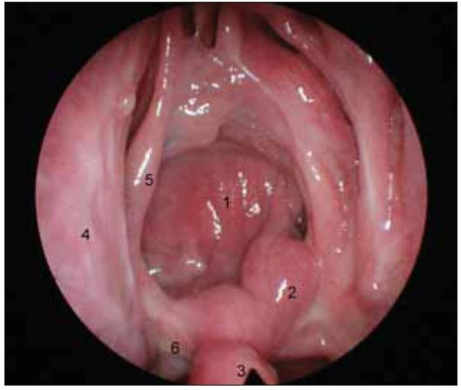 Endoskopický pohled do nosní dutiny měsíc po exstirpaci kraniofaryngeomu.
1. klínová dutina vystlána nazoseptálním lalokem, 2. stopka laloku, 3. septum nosní (kaudální okraj resekované části), 4. střední skořepa vpravo (vlevo byla střední skořepa resekována), 5. horní skořepa vpravo, 6. horní okraj choany vpravo