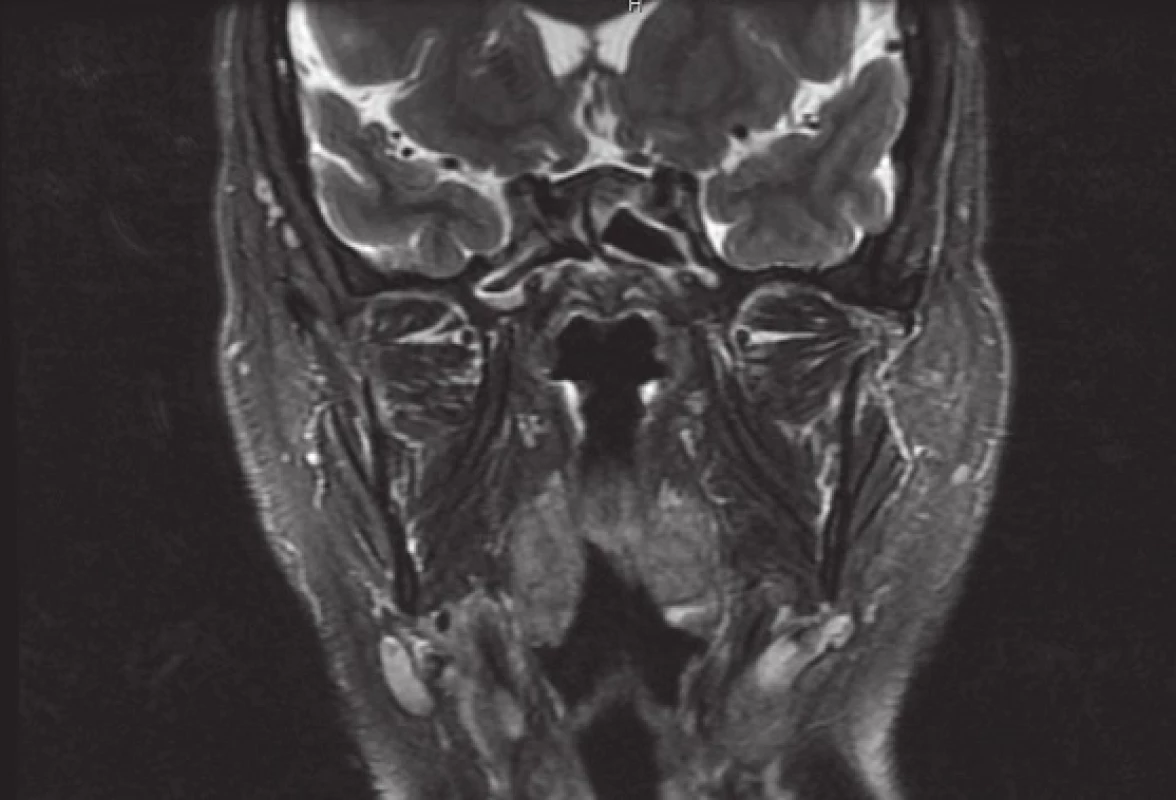 Kontrolní MRI snímek, T2 vážený, bez známek recidivy tumoru.