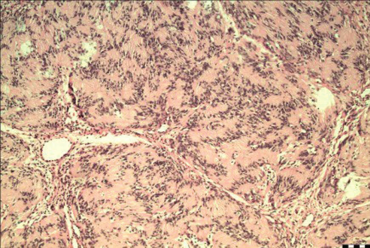 Benígny schwannóm. Palisádovanie vretenovitých buniek bez cytologickej atypie- Antoni typ A (HE 200x).