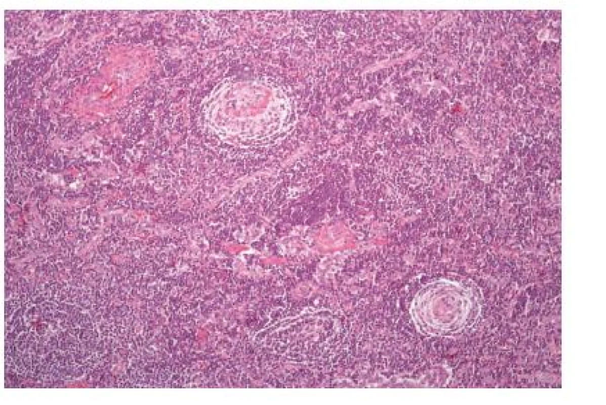 Histopatologický nález – Hyalinně-vaskulární typ Castlemanovy choroby, barvení HE.