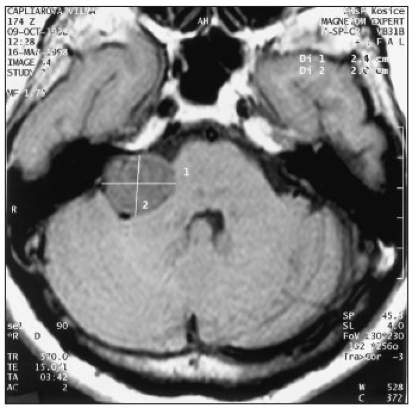 Vestibulárny schwannom vpravo veľkosti 2,4 cm, ktorý už má charakter veľkého tumoru.