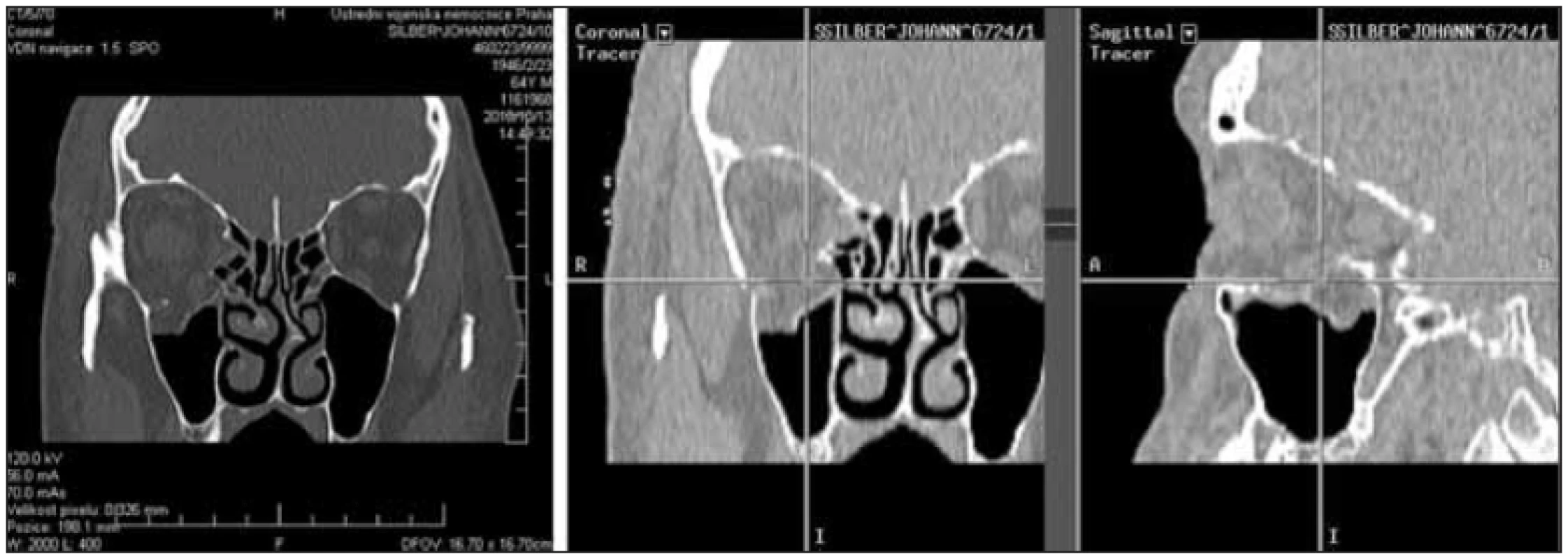 Využití CT navigace k ověření správné mobilizaci a fixace zlomeniny spodiny očnice (subciliární přístup, PMR dlaha).