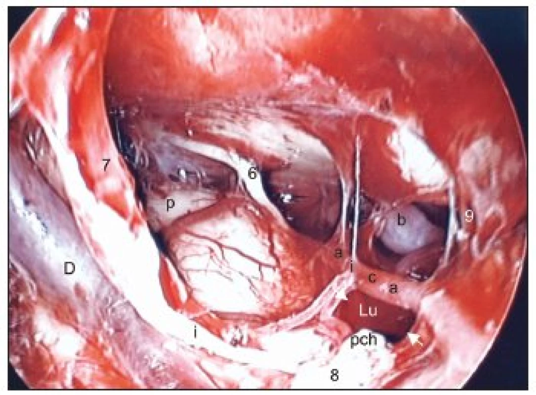 Translabyrintný prístup po odstránení tumoru vpravo – endoskopia ukazuje, že krvácanie je zastavené, pontocerebelárny priestor je vypláchnutý, čistý.
Legenda: D - Dandyho véna, i - nervus intermedius, 7 - nervus facialis, 8 - zvyšok nervus cochleovestibularis, pch - plexus chorioideus, p - pons Varoli, 6 - nervus abducens, b - arteria basilaris, 9 - nervus glossopharyngeus, aica - arteria cerebellaris anterior inferior, Lu - foramen Luschkae