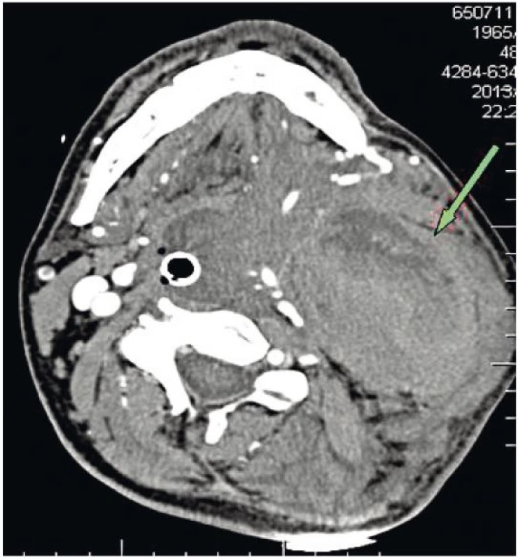 CT zobrazení v axiální projekci masivního hematomu u zaintubovaného pacienta s dislokací a. carotis, uzávěrem v. jugularis interna a útlakem hrtanu.