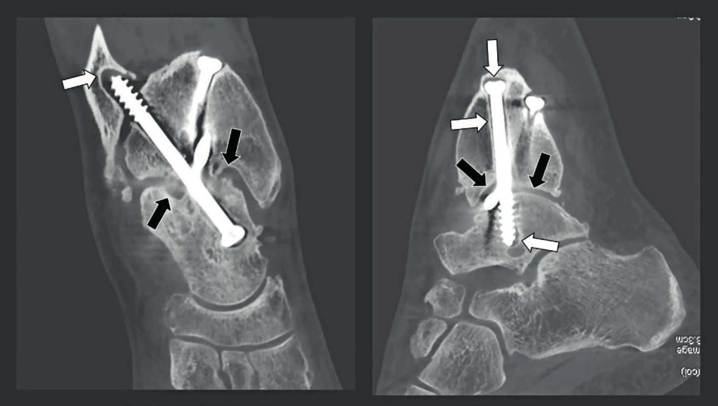 Kontrolní snímky po artrodéze kotníku.