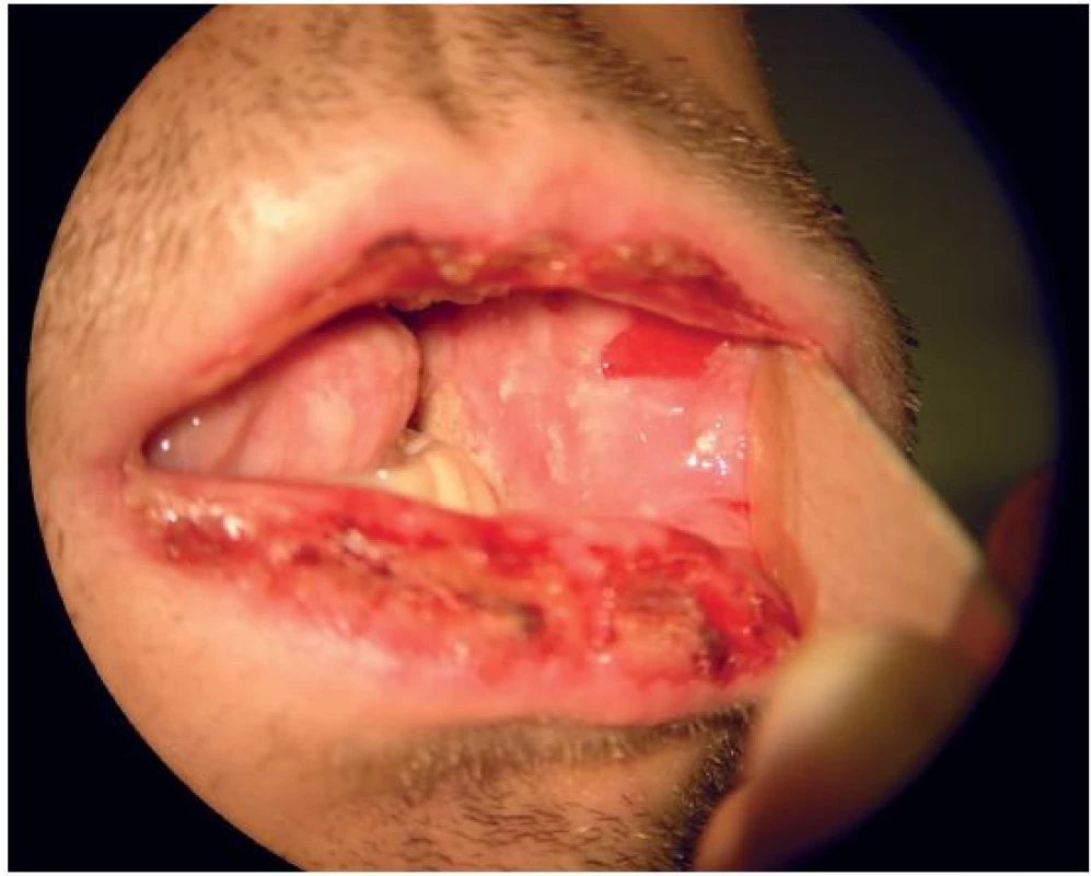 Ulcerózní léze na sliznici ústní dutiny.