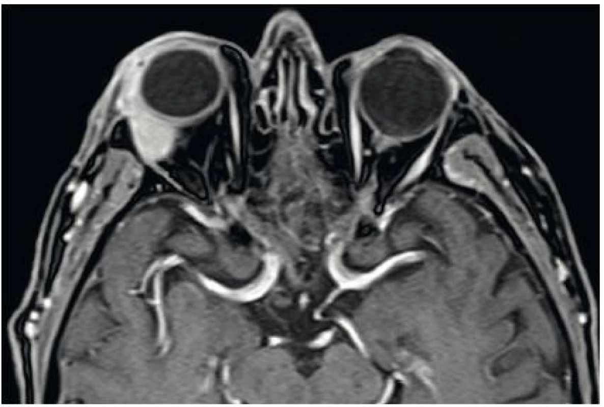 Tumor pravé očnice vycházející ze slzné žlázy, MRI – axiální scan.