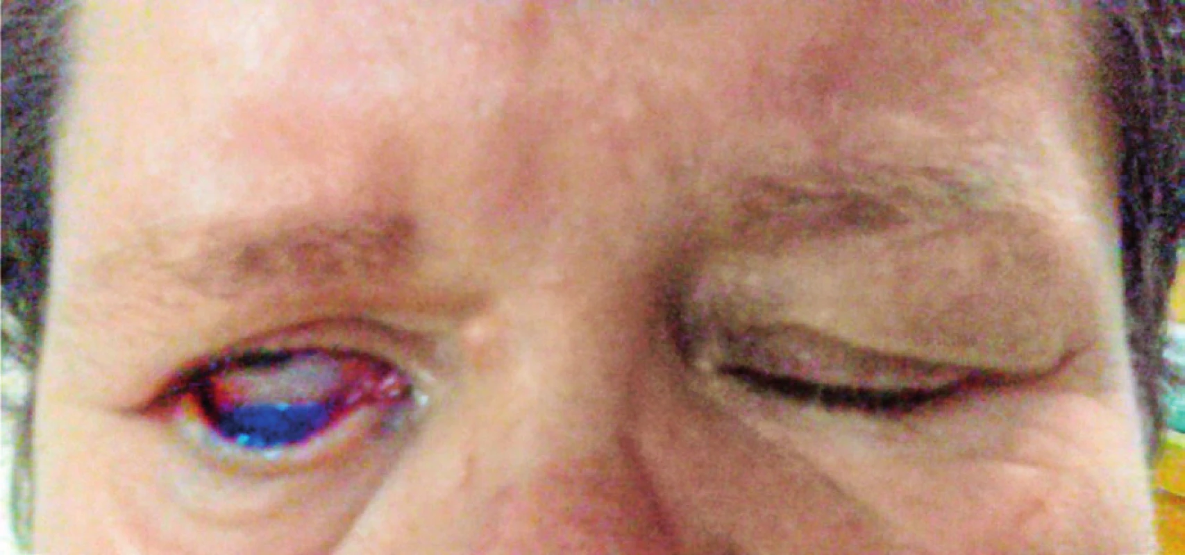 Očná štrbina pri uzávere pri maximálnom úsilí u pacientky s lagoftalmom. Nález zhoršuje výrazné ektropion dolného viečka.