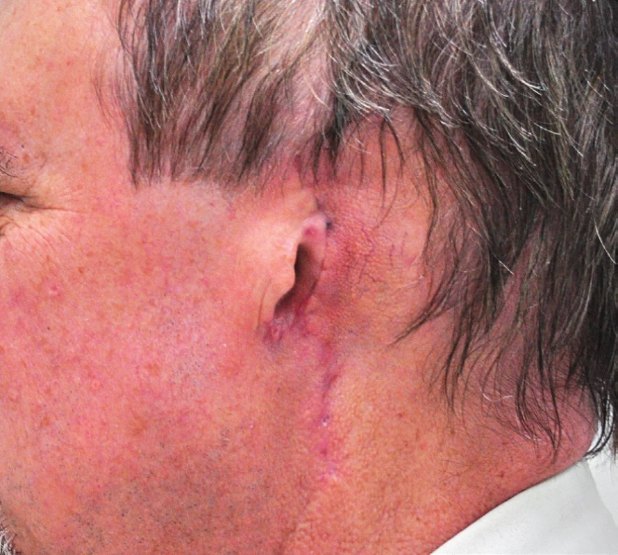 Pacient s melanomem ušního boltce – po operaci.