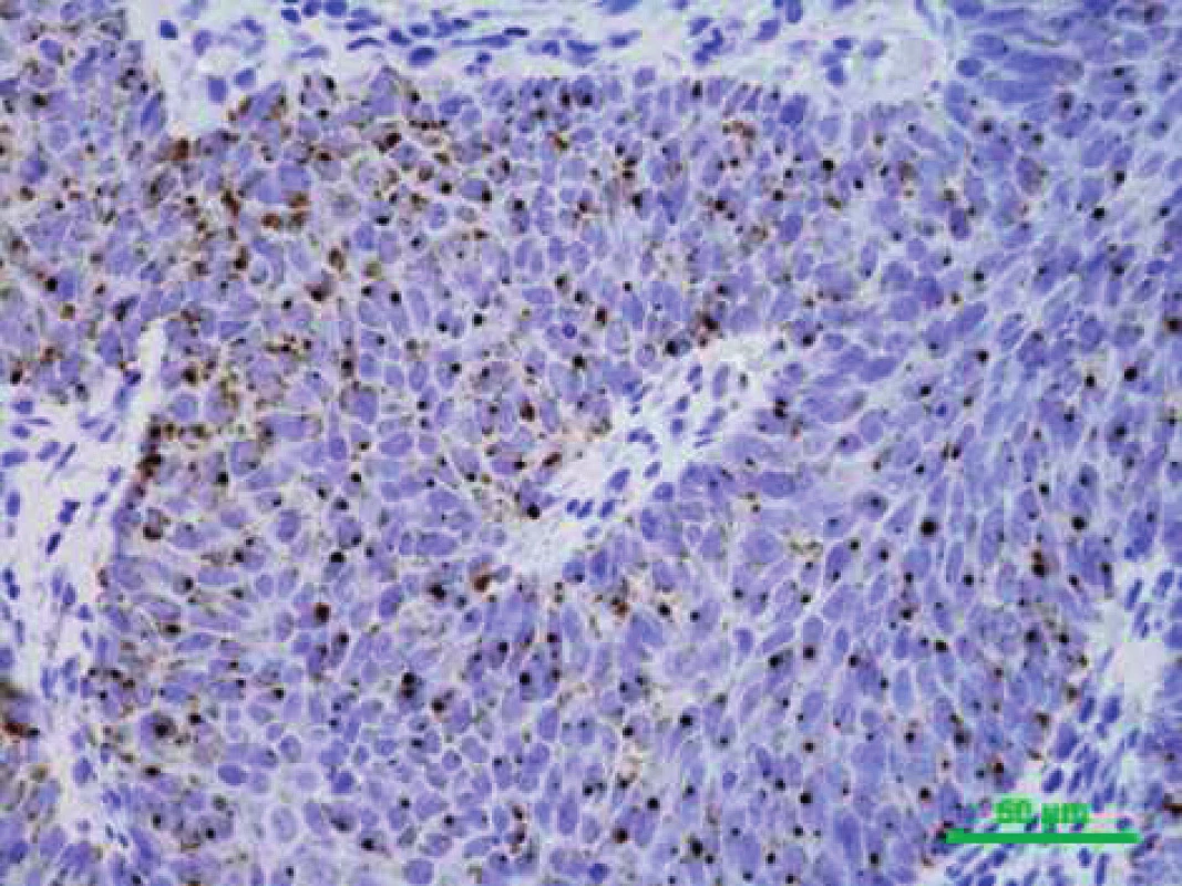 Pozitivní (hnědé zbarvení v buněčných jádrech) chromogenní in situ hybridizace (CISH) s probami proti HPV DNA různých typů, původní zvětšení 400x (PAÚ FN u svaté Anny, Brno).