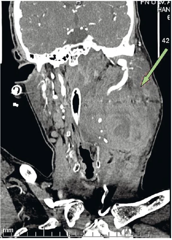 CT zobrazení v koronární projekci masivního hematomu u zaintubovaného pacienta s dislokací a. carotis, uzávěrem v. jugularis interna a útlakem hrtanu.