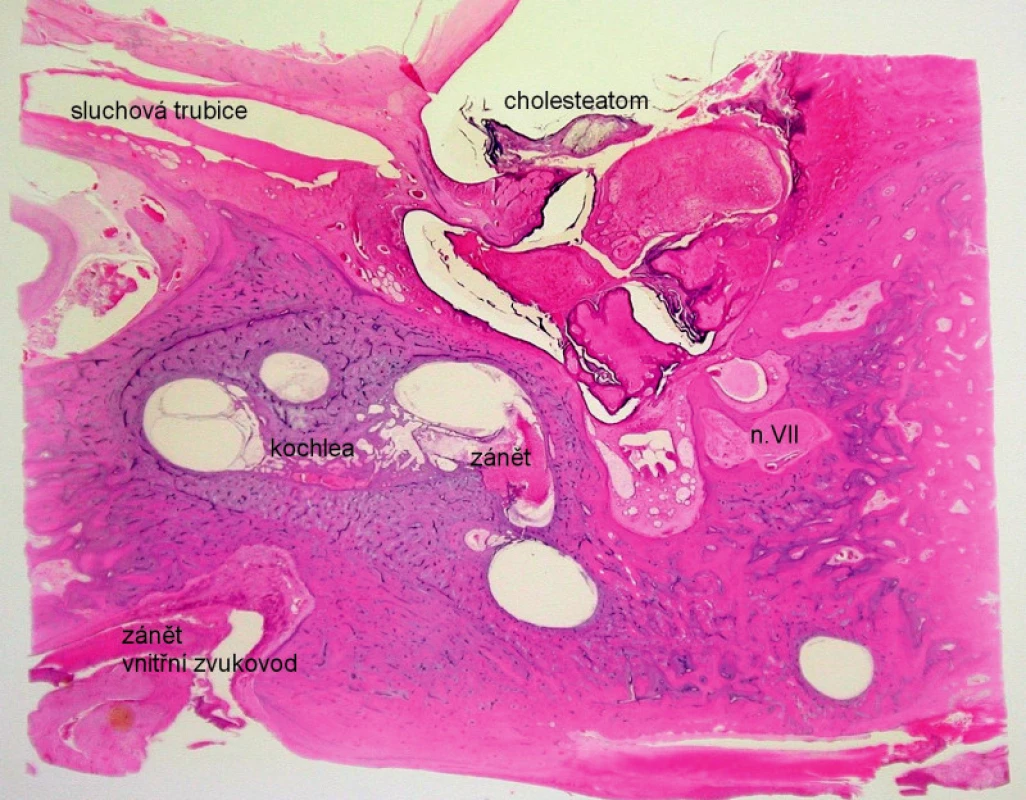 Chronická hnisavá labyrintitida – zánětlivý infiltrát v bazálním závitu hlemýždě. Kazuistika 3. - histologický obraz, horizontální řez pravou spánkovou kostí, barvení hematoxylin eozin.